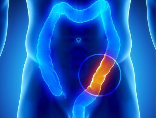 Tumor de Cólon